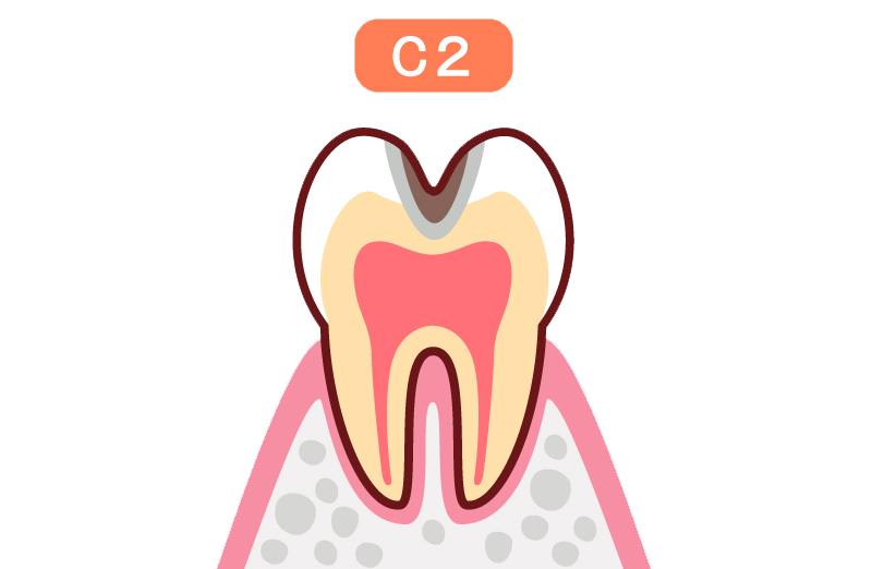 C2(エナメル質の虫歯)