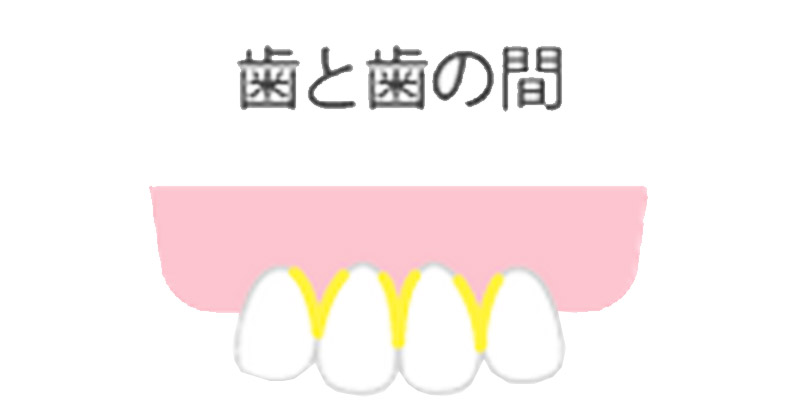 虫歯治療|大西歯科医院